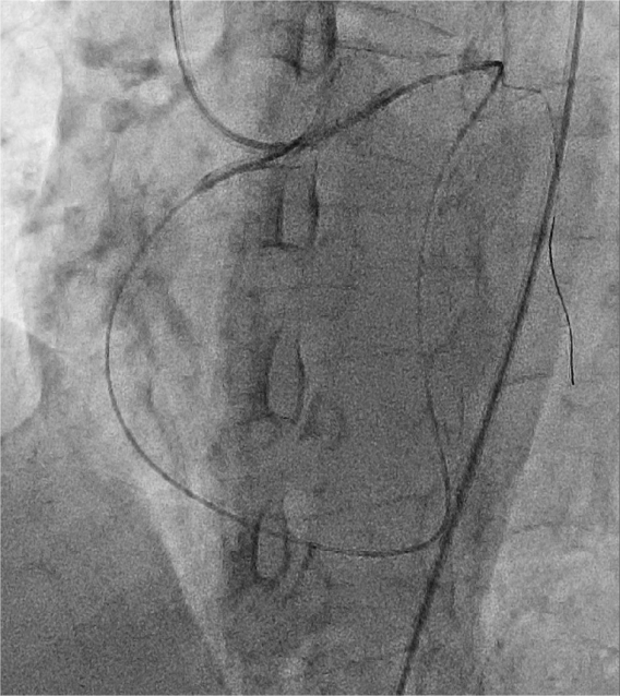 逆行导丝全 逆行导丝全